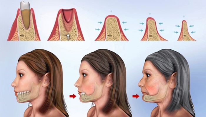 nhổ răng cấm có cần trồng lại nhổ răng cấm có cần trồng lại