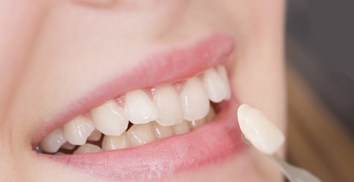 phủ răng sứ nano có bền không