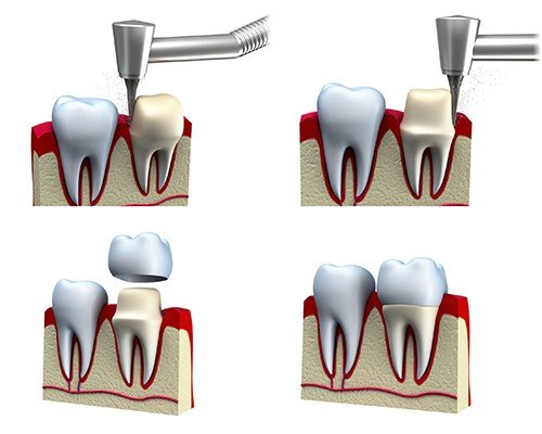phương pháp bọc răng sứ là gì