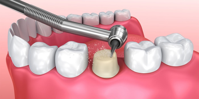 quy trình bọc răng sứ zirconia