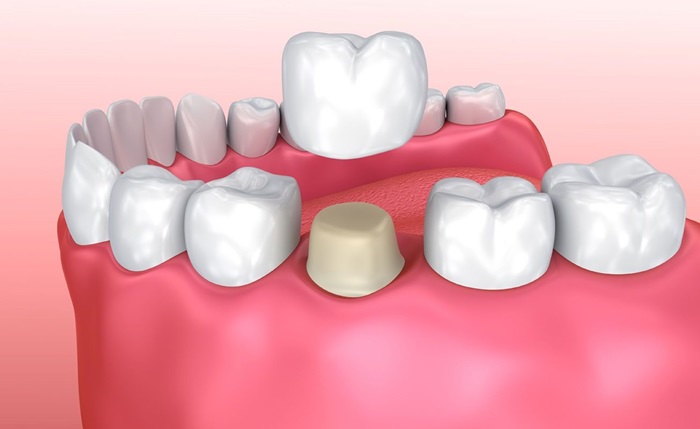 quy trình bọc răng sứ zirconia