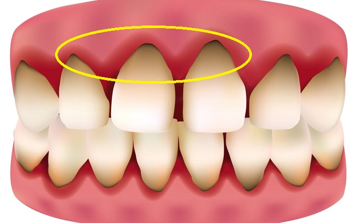 răng hàm sứ Titan