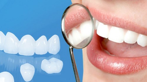 răng phủ sứ nano là gì
