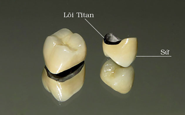 răng sứ Titan sử dụng được bao lâu