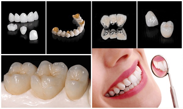 răng sứ Titan và răng sứ zirconia