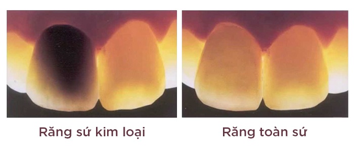 răng sứ Titan và răng sứ zirconia
