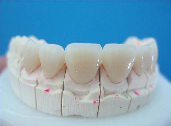 răng sứ cercon và titan
