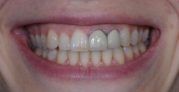 răng sứ crom coban là gì