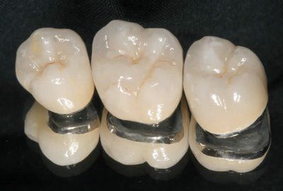 răng sứ dresden