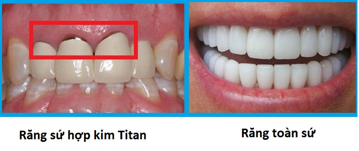 răng sứ hợp kim Titan