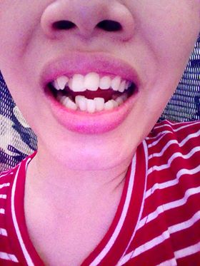 răng sứ không kim loại là gì