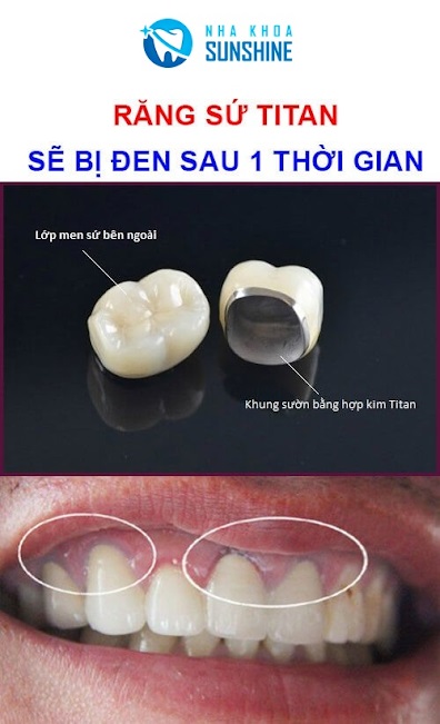 răng sứ kim loại bị đen