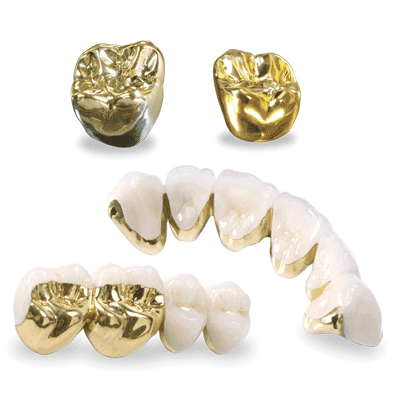 răng sứ kim loại quý