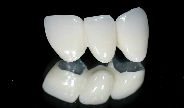 răng sứ kim loại và răng sứ Titan