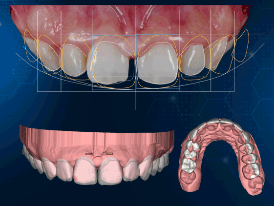 răng sứ nano 6d