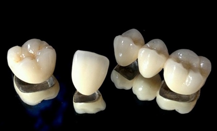 răng sứ Titan HCM