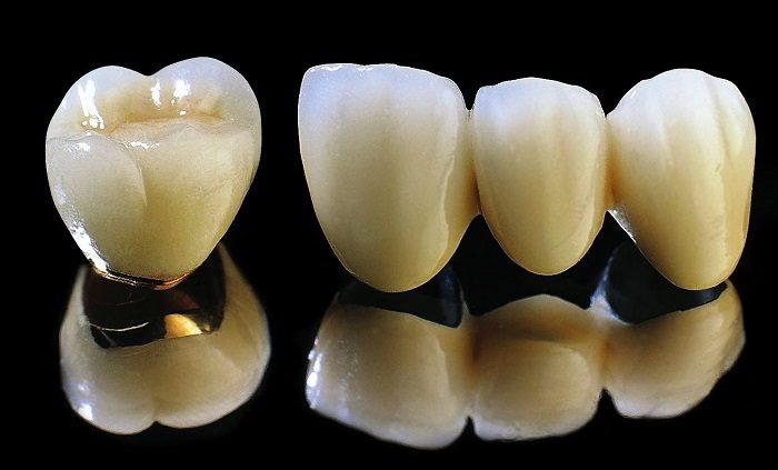 răng sứ Titan giảm giá