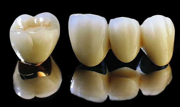 răng sứ Titan Hà Nội