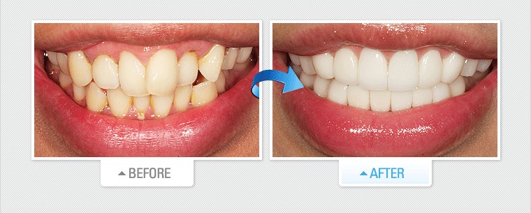 răng sứ veneer là gì