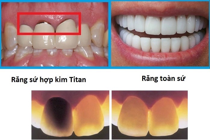 răng sứ vita là gì