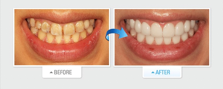 review răng dán sứ