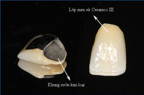tác hại của bọc răng sứ kim loại