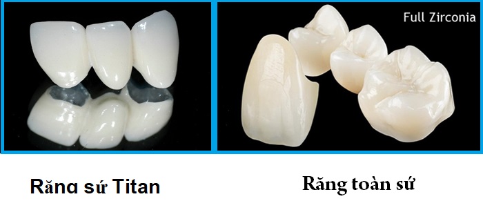 tìm hiểu về răng sứ titan