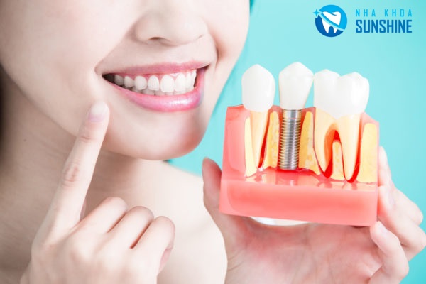 trồng 2 răng hàm trồng 2 răng hàm