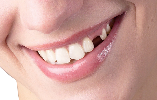 trồng răng 1 cái trồng răng 1 cái
