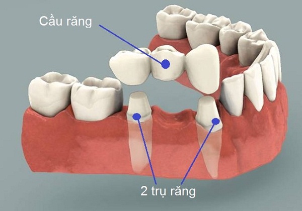 trồng răng bắc cầu bao nhiêu tiền trồng răng bắc cầu bao nhiêu tiền