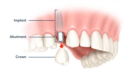 trồng răng cấm bị mất trồng răng cấm bị mất