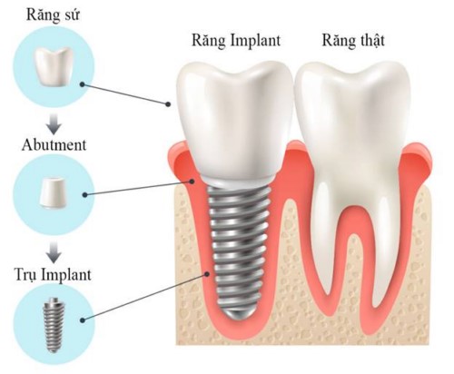 trồng răng cấm giá bao nhiêu trồng răng cấm giá bao nhiêu