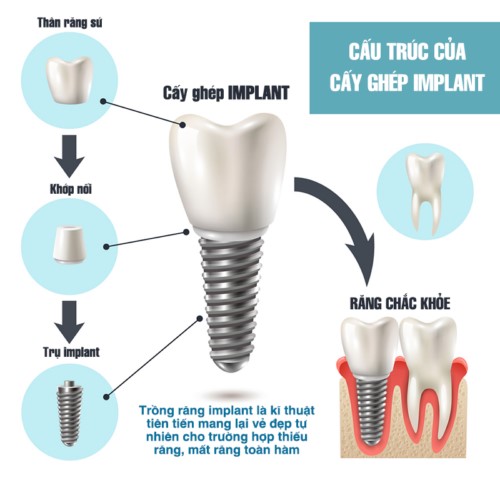 trồng răng cho người già