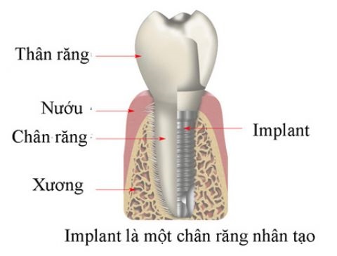 trồng răng cho người lớn tuổi trồng răng cho người lớn tuổi