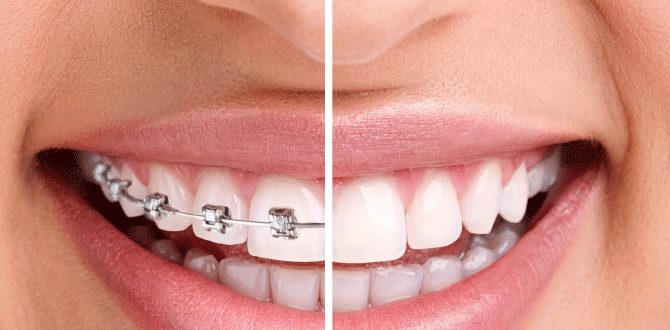 trồng răng có niềng được không trồng răng có niềng được không