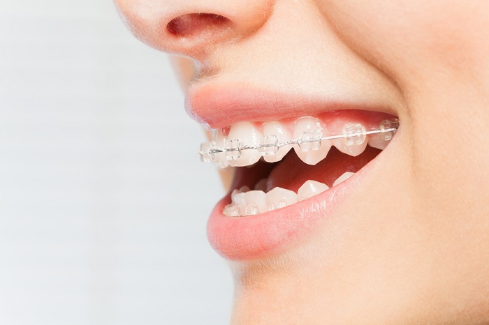 trồng răng có niềng được không trồng răng có niềng được không
