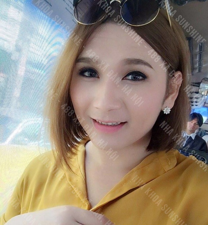 trồng răng cửa cố định