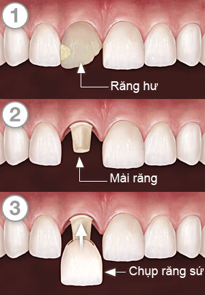 trồng răng cửa giả trồng răng cửa giả