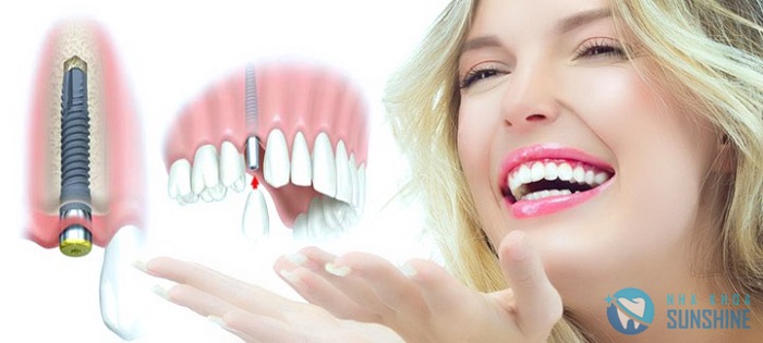 trồng răng cửa vĩnh viễn