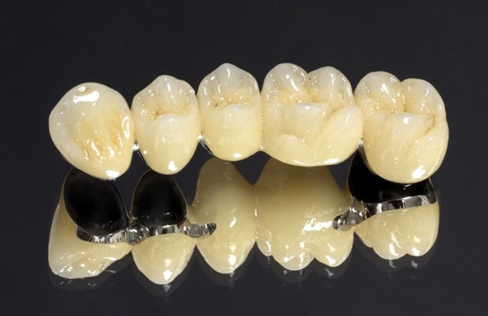 trồng răng giả bị hôi