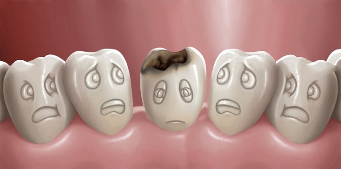 trồng răng giả bị hôi