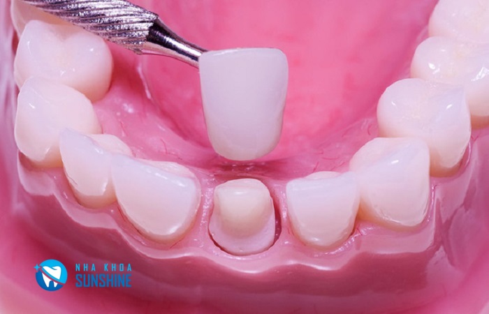 trồng răng giả bị hôi
