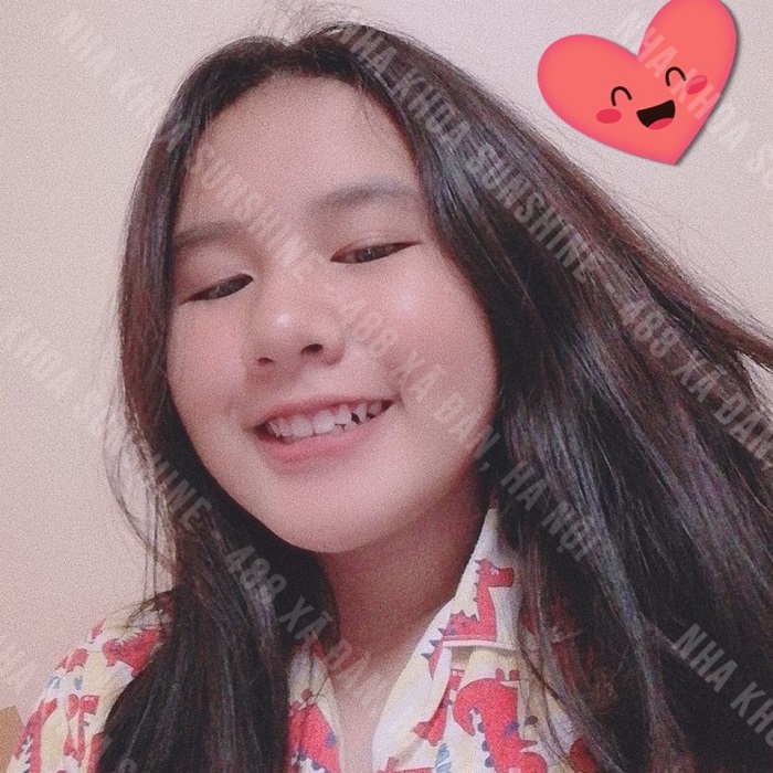 trồng răng giả cho trẻ em
