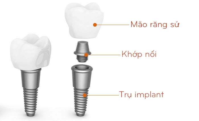 trồng răng giả cố định giá bao nhiêu