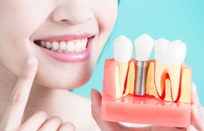 trồng răng giả cố định như thế nào