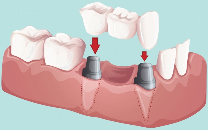 trồng răng hàm bị mất