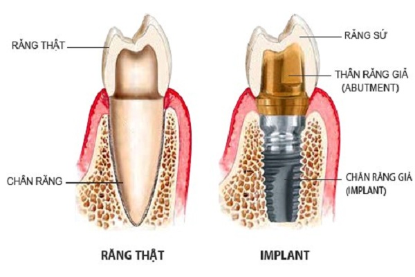 trồng răng hàm bị mất