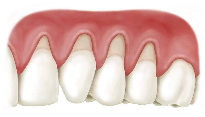 trồng răng hàm bị mất