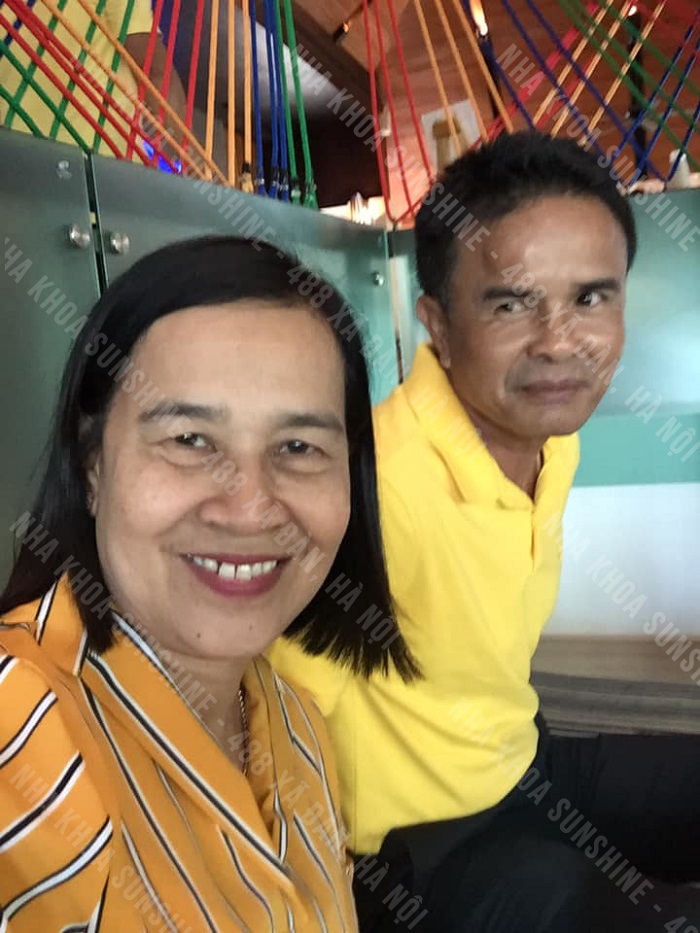 trồng răng hàm giả bao nhiêu tiền