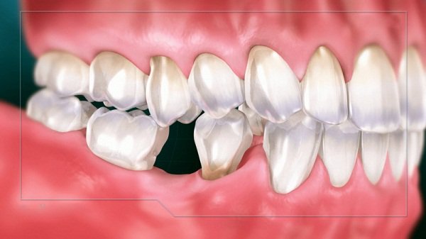 trồng răng hàm mất bao nhiêu thời gian